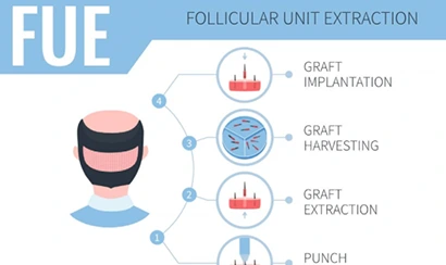 FUE - Haartransplantation