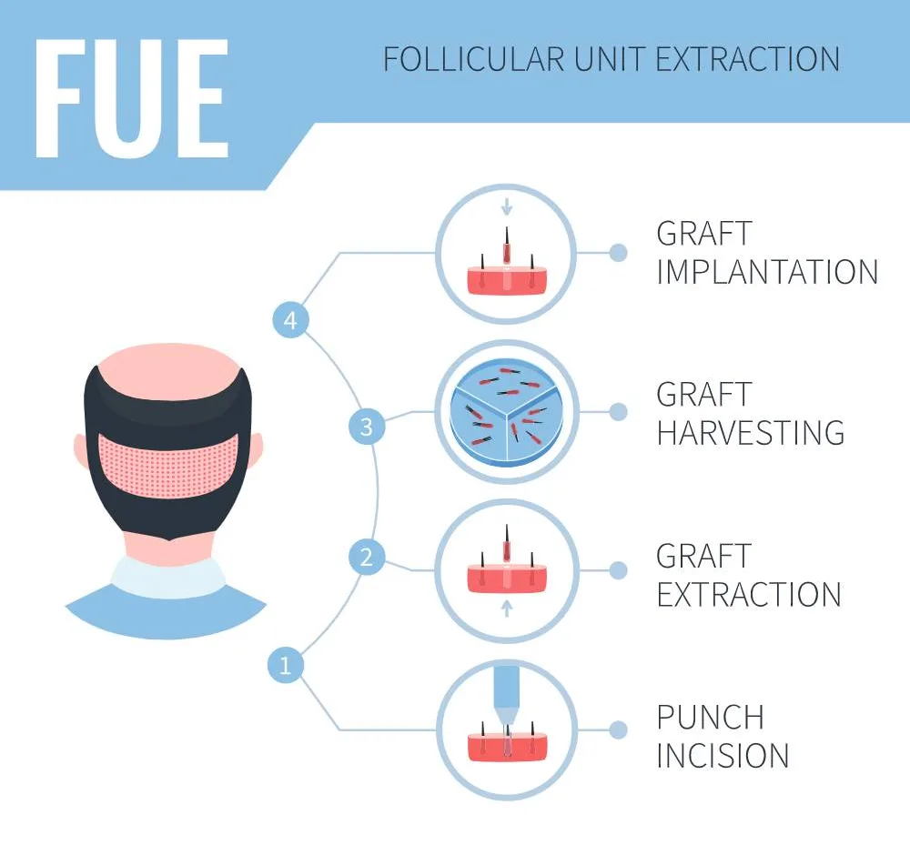 FUE